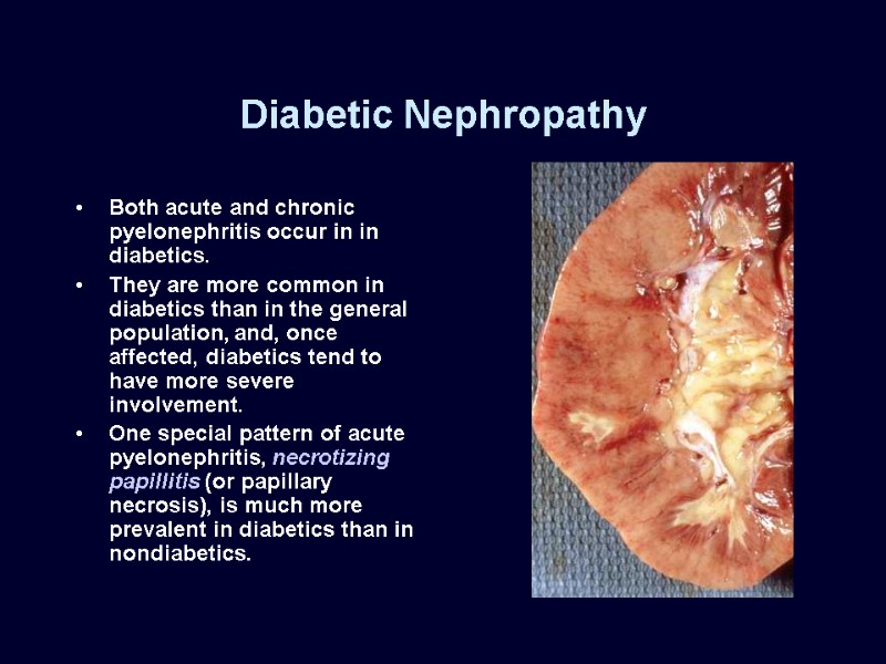 Diabetic Nephropathy Both acute and chronic pyelonephritis occur in in diabetics. They are more